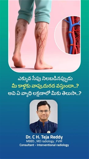 Leg Swelling After Standing? It Could Be Varicose Veins | When to See a Doctor | Dr. C H. Teja Reddy