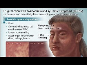 Drug Reaction with Eosinophilia and Systemic Symptoms (DRESS) Syndrome #like #medical #medicine