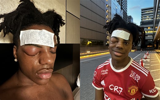 Is IShowSpeed still hospitalized? Latest reports on swollen eye and cluster headache explored