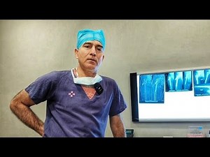 Infection and Hip Replacement# After Infection #Multiple Surgery#But Normal Life# by Mis Technique