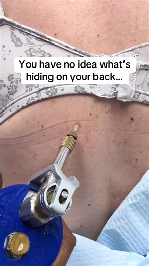 That spot hiding under your bra? It’s an sk and it can be removed. #seborrheickeratosis #cryotherapy #fyp