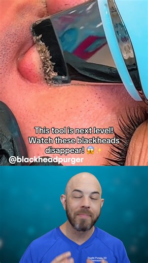 Pore spatula to the rescue💥👊 (credit: @blackheadpurger on TT) #satisfying #pores #acne | Dr. Dustin Portela, Dermatologist