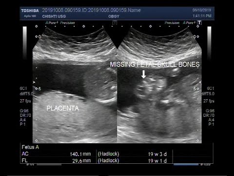 Ultrasound Video showing Anencephaly - a neural tube defect.