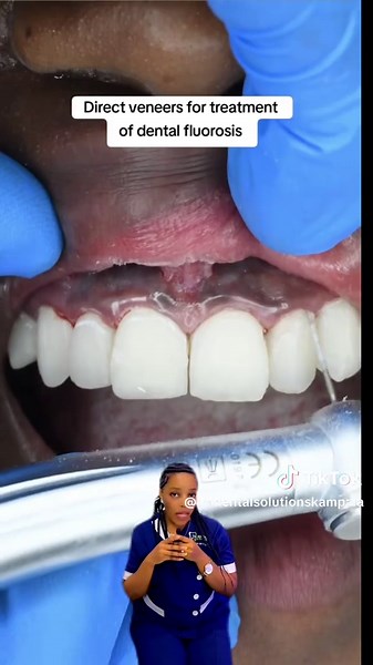 Effective Solutions for Dental Fluorosis Treatment