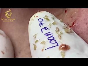Blackheads removal and popping pimple (370) | Loan Nguyen