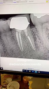 19K views · 190 reactions | Not every J shaped lucency a VRF. I did not use a cbct. Ask me how I knew. #dentistry #dentalschool #hygienists #rootcanaltherapy | Advanced Micro-Endodontics | Facebook