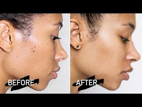 Dermatosis Papulosa Nigra Removal Before/After