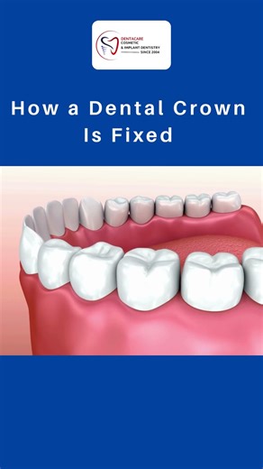 How a Dental Crown Is Fixed | Best Dental Clinic in Bannerghatta Road | Dental crown Service