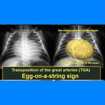 cardiomegaly with pulmonary plethora (TGA VS. TAPVR VS. TA) short case