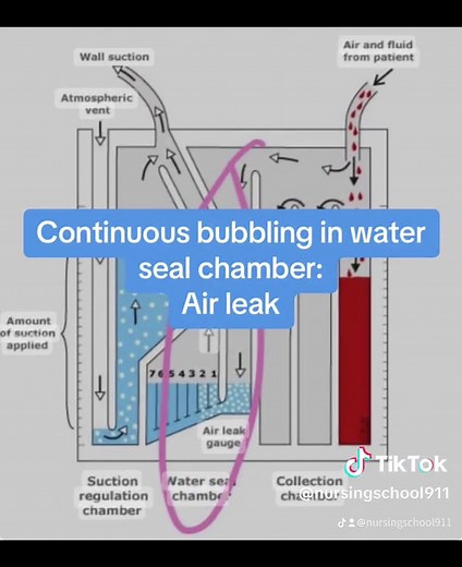 Chest Tubes: Essential Facts for Your Respiratory Exam