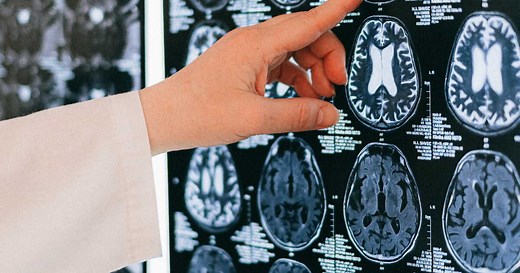 Syndrome cérébelleux : causes, symptômes, évolution, traitement