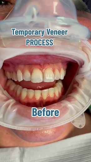 The temporary veneer process is the first step in your #smilemakeover journey. Follow along as Dr. Tejas Patel prepares the teeth, takes impressions to ensure the perfect fit and the placement of the temporary veneers. This patient will return in 2 weeks for their #porcelainveneers. If you are ready to start your journey click the link in our bio. #austinveneers #dallasveneers #dallasdentist #nyveneers #njveneers #cosmeticdentistry #howcosmeticdentistmakeveneers #theporcelainveneerprocess #stem