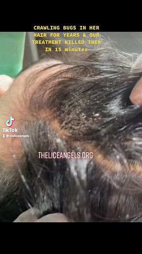 Effective Lice Treatment: From Infestation to Elimination in 15 minutes!
