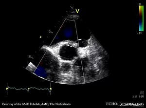 File:Abscess of aortic valve prosthesis E00501 (CardioNetworks ECHOpedia).webm - Wikimedia Commons