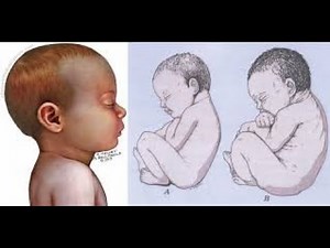 Fetal or Baby Macrosomia Or large for gestational age ; baby is significantly larger than average