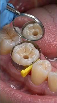 Hidden Interproximal Cavity Restoration | Class II Composite Filling