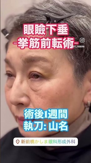【術前&術後】眼瞼下垂症に対する挙筋前転術