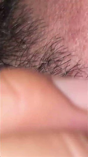#blackheadcaique #pimple #oddlysatisfying #blackheads #thebarbersarms #satisfying #relax #skincare