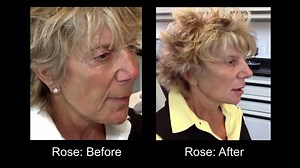 Learn How You Can Gain Volume in the Cheeks With Restylane Lyft
