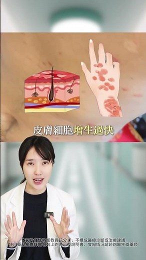 身體一塊塊紅斑，還會有紅色鱗屑