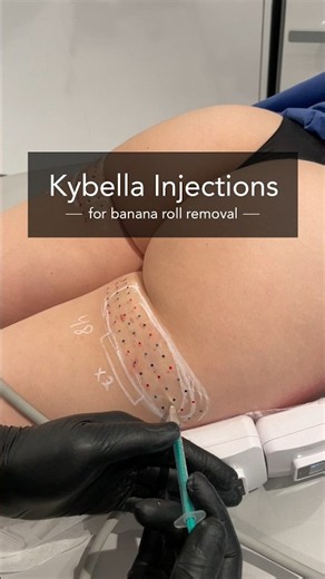 Kybella for Banana Roll Fat Removal | Dr. Hooman Khorasani NYC