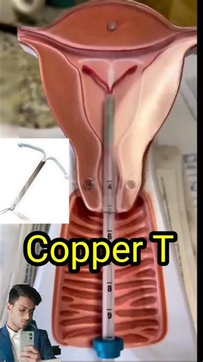 Copper T #copper-t #iud #contraception #contraceptivepill #doctor #gynecologist