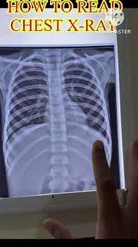 How to Read a Chest XRay | Step-by-Step Radiology Guide”#medicaleducation #hospitals #mbbs #clinical