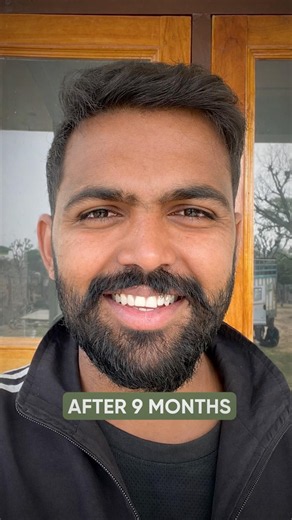 9 Months Hair Transplant Result | Latest Fue Technique #shorts #viral #hair