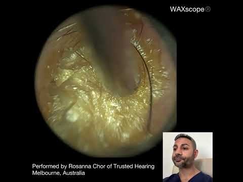 497 - Watch Ear Wax Removal by Rosanna Chor of Trusted Hearing in Melbourne 🇦🇺 using the WAXscope®️