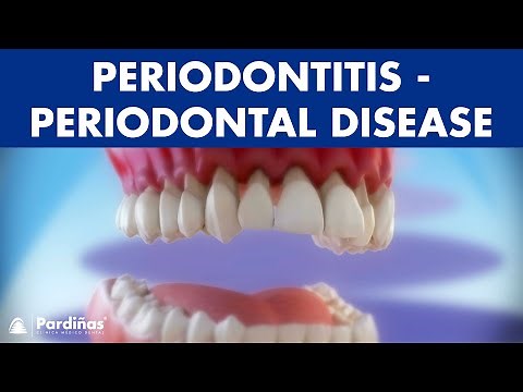 Gum disease - Periodontitis - Periodontal Disease ©