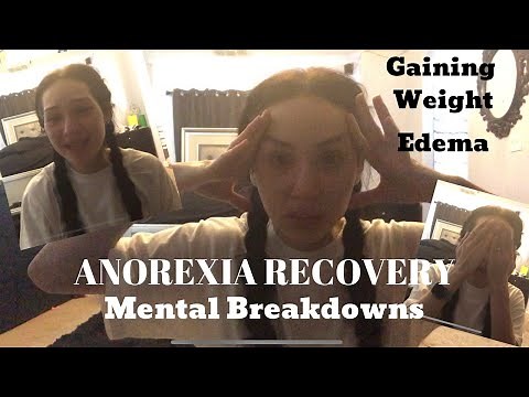 Anorexia Recovery | Recovery Meltdowns | Edema and Gaining Weight