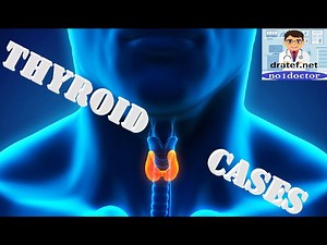 Thyroid Cases Atlas /Thyroid Diseases/Thyroid Problems/ Thyroid Surgery/ No1doctor/ dratef /Mrcs