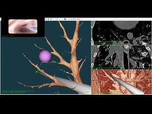 Open Source Virtual Bronchoscopy using CUSTUSx and Anser EMT