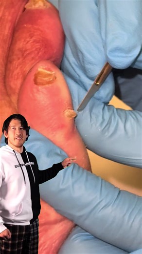 If your baby toe hurts every time you put on shoes… 👟 It might be a corn. Good news: podiatrists remove them quickly, safely, and pain-free — and help keep them from coming back. #faithfootcare #podiatrist #footcare #corn #wellness