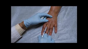Hand Rejuvenation with Filler