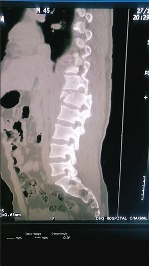 How to CT Lumbar | Spine Anatomy | Spine Fracture | Fracture on CT | Fracture | Fracture reduction