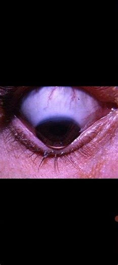 Keratoconus (Rizzuti's Sign) I Eye 👁‍🗨 @#Awerenes of All @#Cornea thin & buldge@#Opthalamology