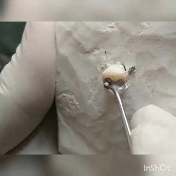 Amalgam Carving and Burnishing