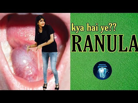 RANULA | plunging ranula | mucocele | treatment of RANULA | dental maestro | dr jyoti
