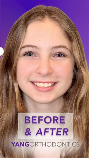 Yang Orthodontics | Dr. Yang | Invisalign Expert on Instagram: "✨👀 Take a look at this unique transformation using a MARA appliance! The MARA, or Mandibular Anterior Repositioning Appliance, is a fixed orthodontic device that helps to push the lower jaw forward to correct severe overbite. Employing this device in treatment helps avoid the need for surgery or headgear. Dr. Yang thought this would be a perfect match for Livie’s smile journey. 🦷 To kick things off the MARA was applied, which bega