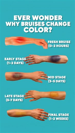Ever noticed how your bruise goes from red to blue, green, and finally yellow before disappearing? 🩵 That color change is actually your body healing itself. When you get a bruise, tiny capillaries under your skin burst, causing blood to leak into the surrounding tissues. This trapped blood appears red or purplish (0–2 hours) because it’s fresh and rich in oxygen. Within a day or two, as the oxygen level drops, the bruise turns blue or dark purple (1–2 days) — this means your body has started br