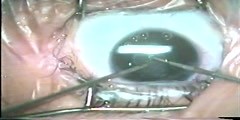 Secondary Cataract