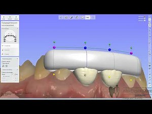 Цифровой Wax up и ключ для переноса/Digital Wax up and transfer key