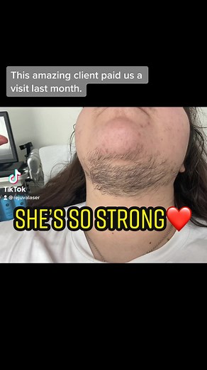 Effective Hair Removal for Hirsutism: Before & After Results