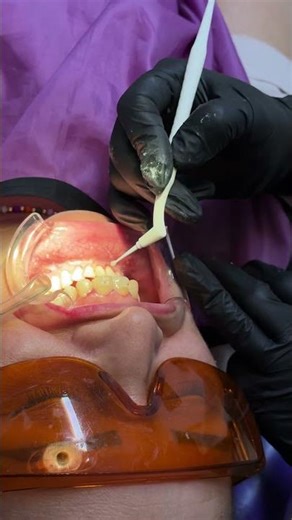 INSTALACIÓN DE ORTODONCIA FIJA INVISIBLE CON BRACKETS CERÁMICOS EN ADULTO 🦷