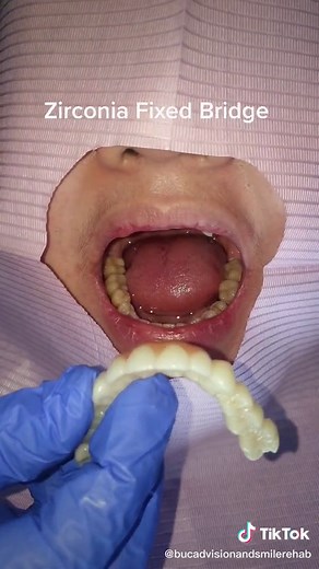 Zirconia Fixed Bridge