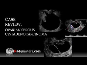 Ultrasound of Ovarian Serous Cystadenocarcinoma