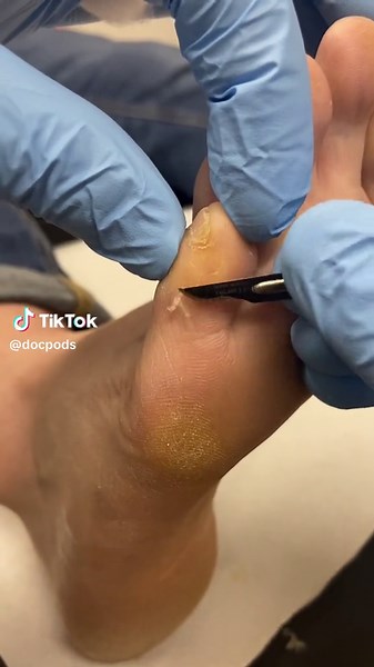 5th Toe Corn and Callus Removal by Podiatrist