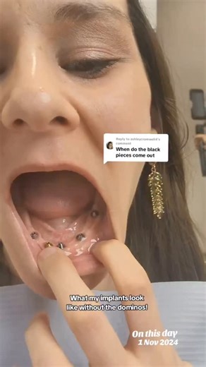 7.6K views · 1.9K reactions | What my All-on-X (6 on top, 5 on the bottom) Dental Implants look like without my arches! This was taken a year ago after surgery & healing. Smile by: @jaximplantsanddentures #dentist #dentistry #toothless #smile #dentalimplants | Denture Dame | Facebook