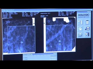 What to expect: Breast Biopsy with X-Ray Guidance at Memorial Healthcare System